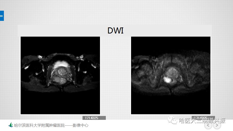 【PPT】胃肠道间质瘤—直肠病例讨论