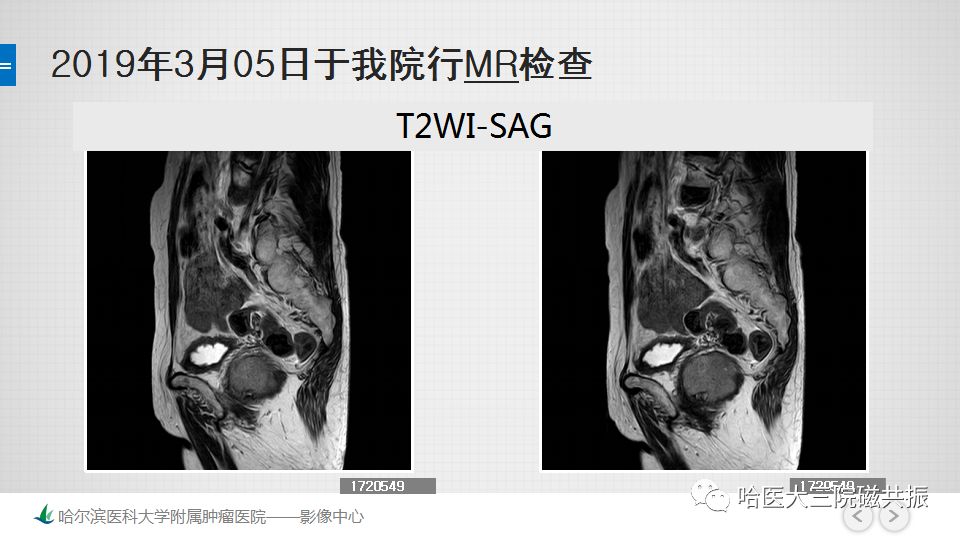 【PPT】胃肠道间质瘤—直肠病例讨论