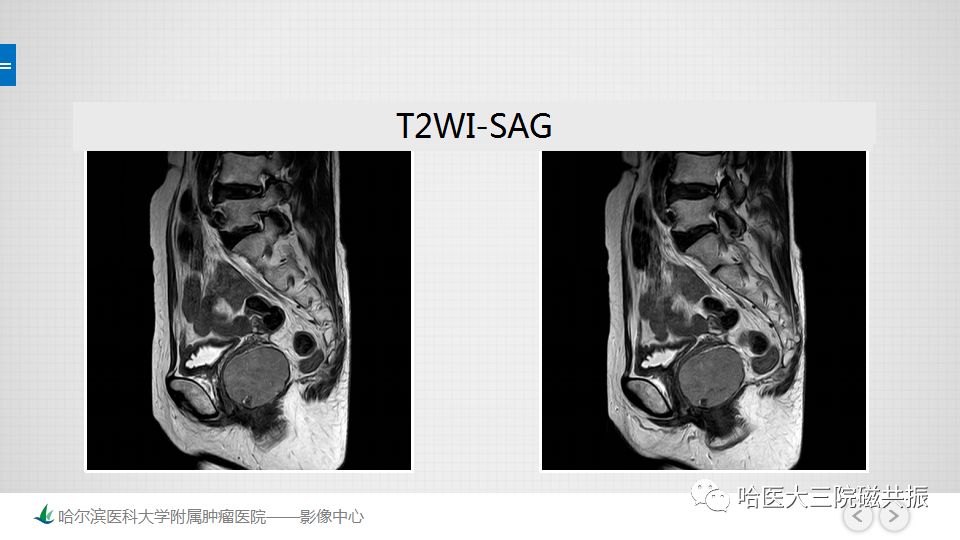 【PPT】胃肠道间质瘤—直肠病例讨论