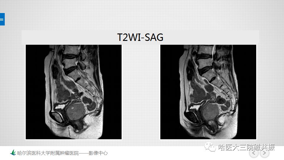 【PPT】胃肠道间质瘤—直肠病例讨论