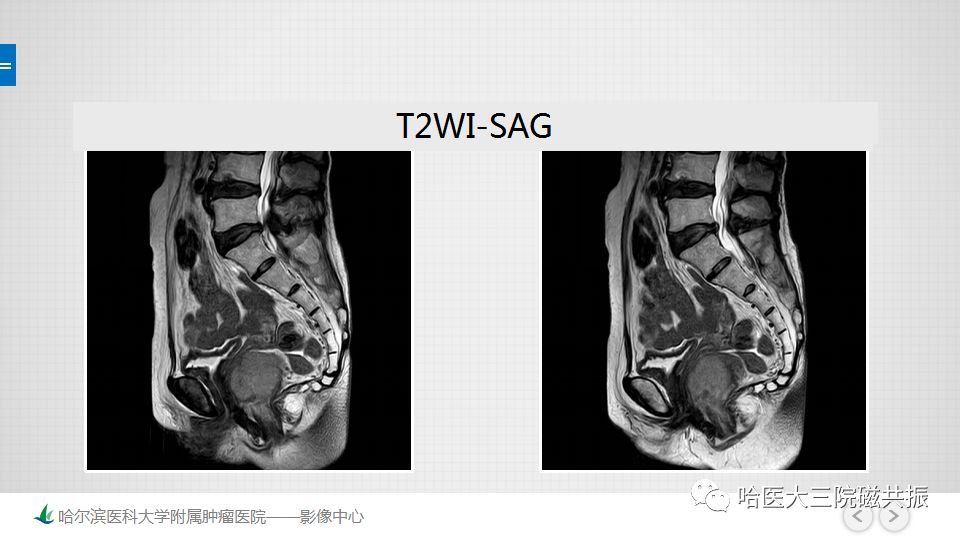 【PPT】胃肠道间质瘤—直肠病例讨论