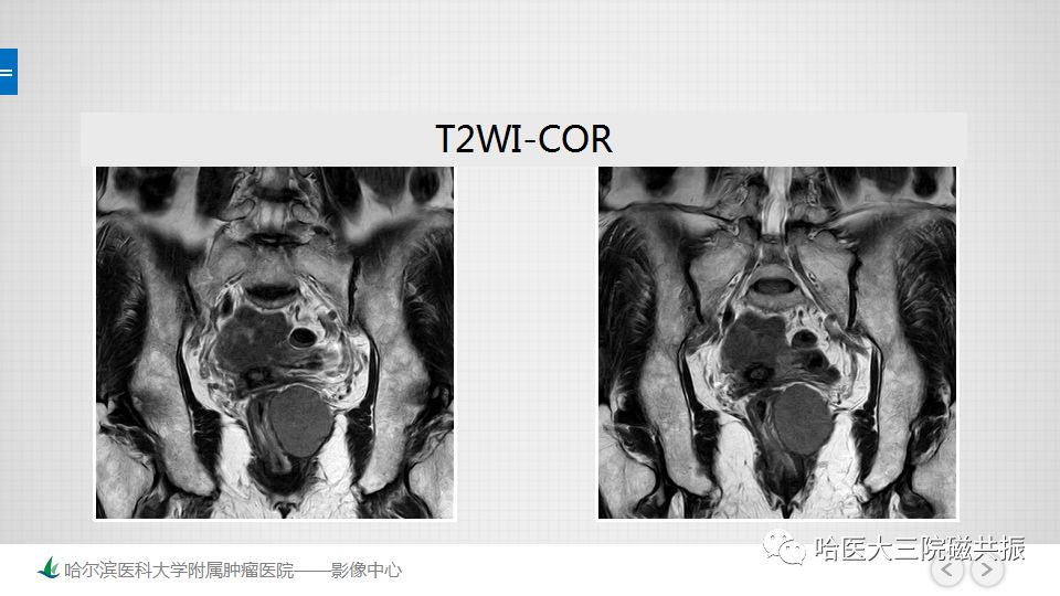 【PPT】胃肠道间质瘤—直肠病例讨论