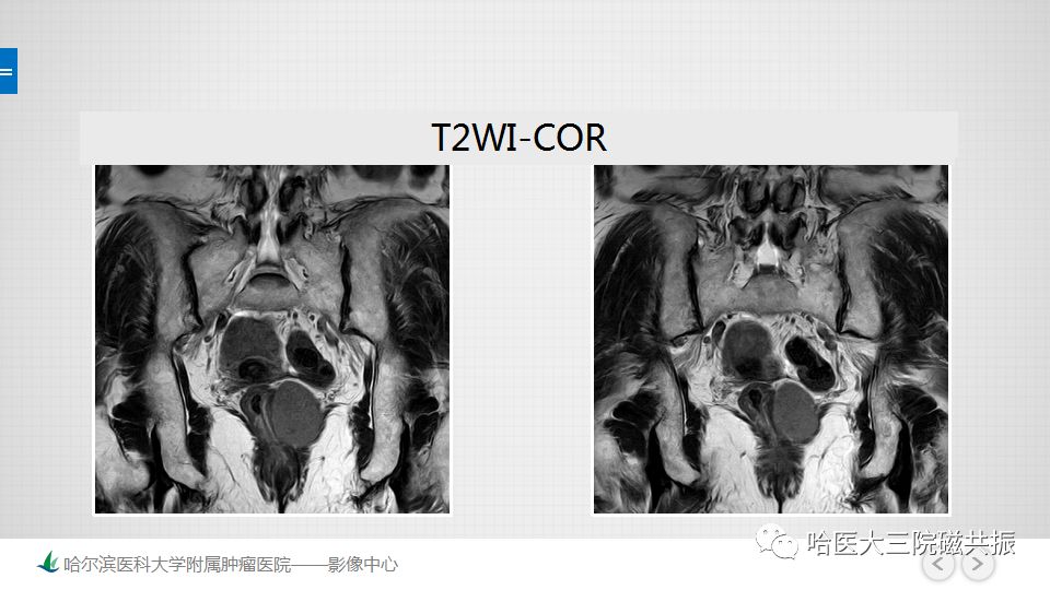 【PPT】胃肠道间质瘤—直肠病例讨论