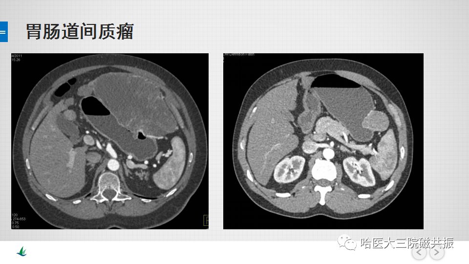 【PPT】胃肠道间质瘤—直肠病例讨论