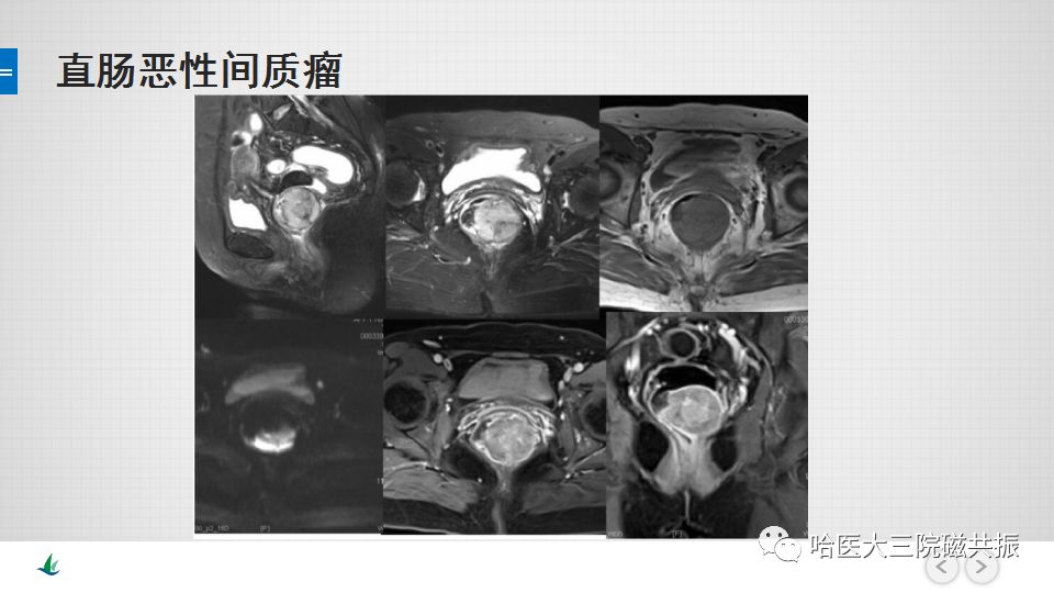 【PPT】胃肠道间质瘤—直肠病例讨论