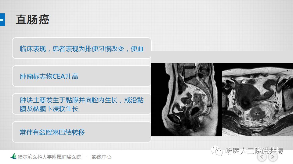 【PPT】胃肠道间质瘤—直肠病例讨论