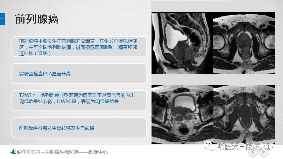 【PPT】胃肠道间质瘤—直肠病例讨论