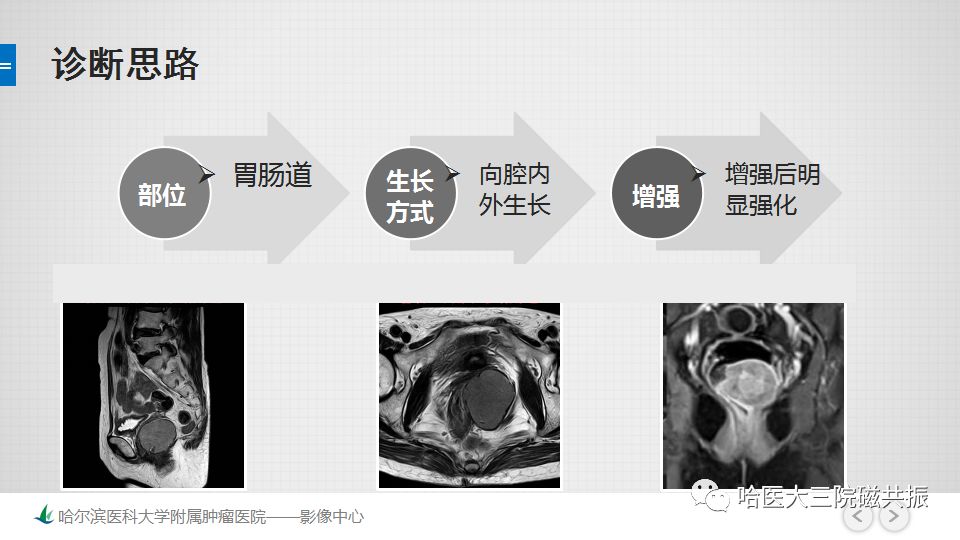【PPT】胃肠道间质瘤—直肠病例讨论
