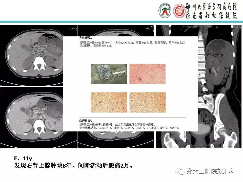 【PPT】肾上腺神经节细胞瘤
