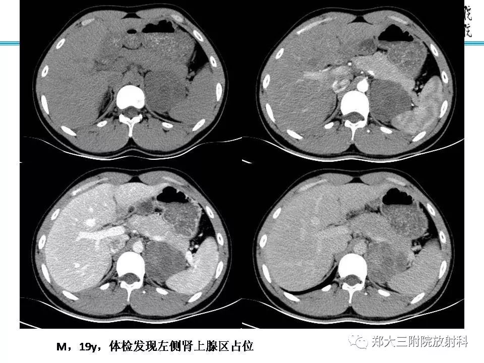 【PPT】肾上腺神经节细胞瘤