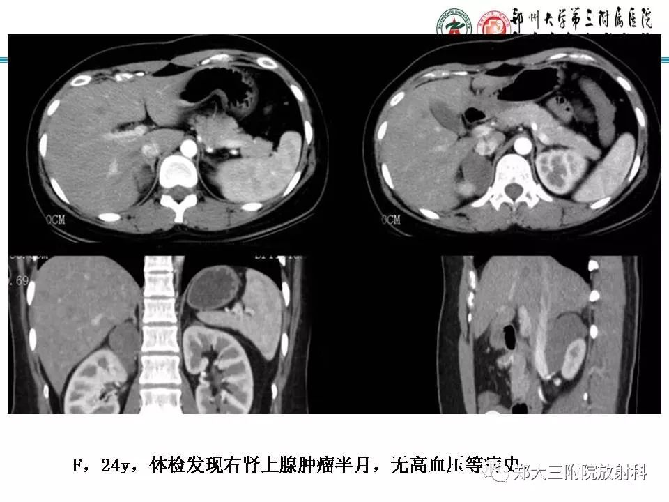 【PPT】肾上腺神经节细胞瘤