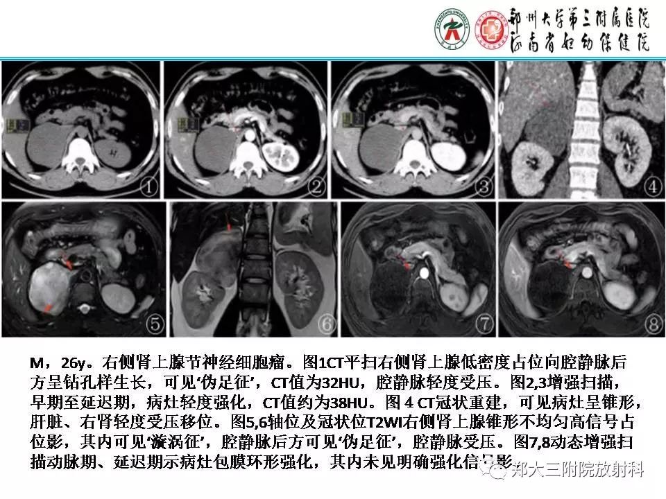 【PPT】肾上腺神经节细胞瘤