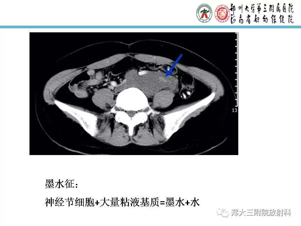 【PPT】肾上腺神经节细胞瘤