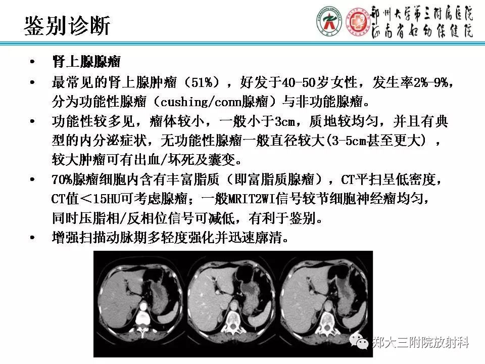 【PPT】肾上腺神经节细胞瘤