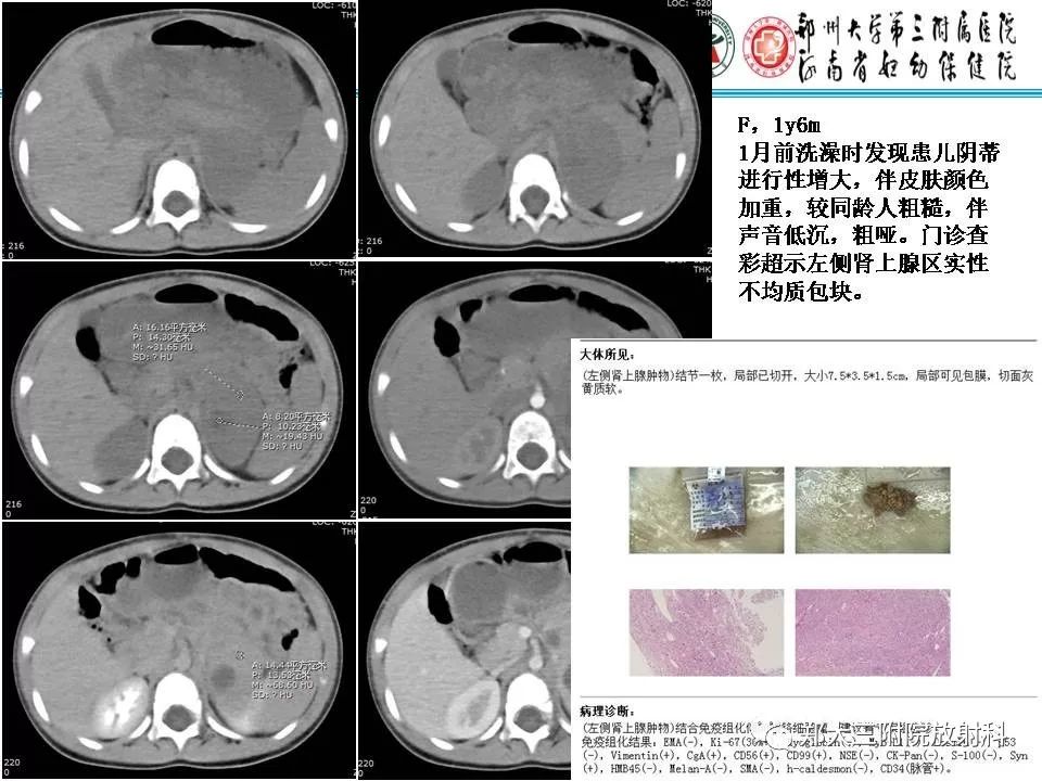 【PPT】肾上腺神经节细胞瘤