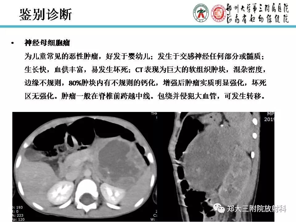 【PPT】肾上腺神经节细胞瘤