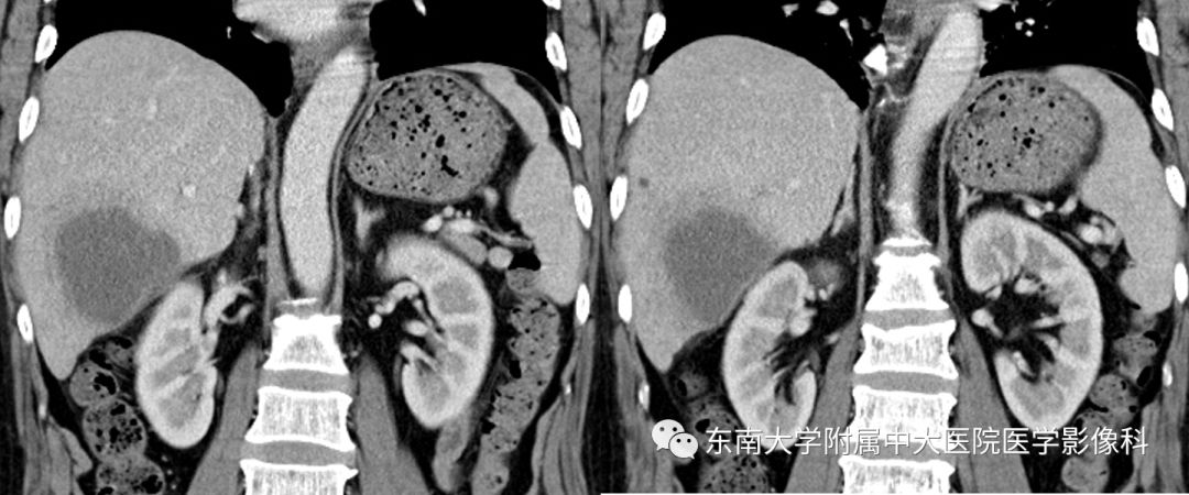 【PPT】肝占位性病变(3例)影像随访