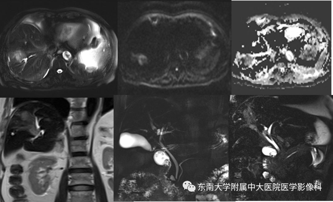 【PPT】肝占位性病变(3例)影像随访
