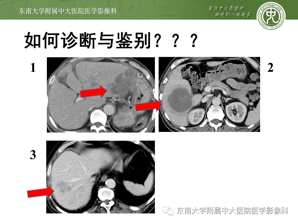 【PPT】肝占位性病变(3例)影像随访