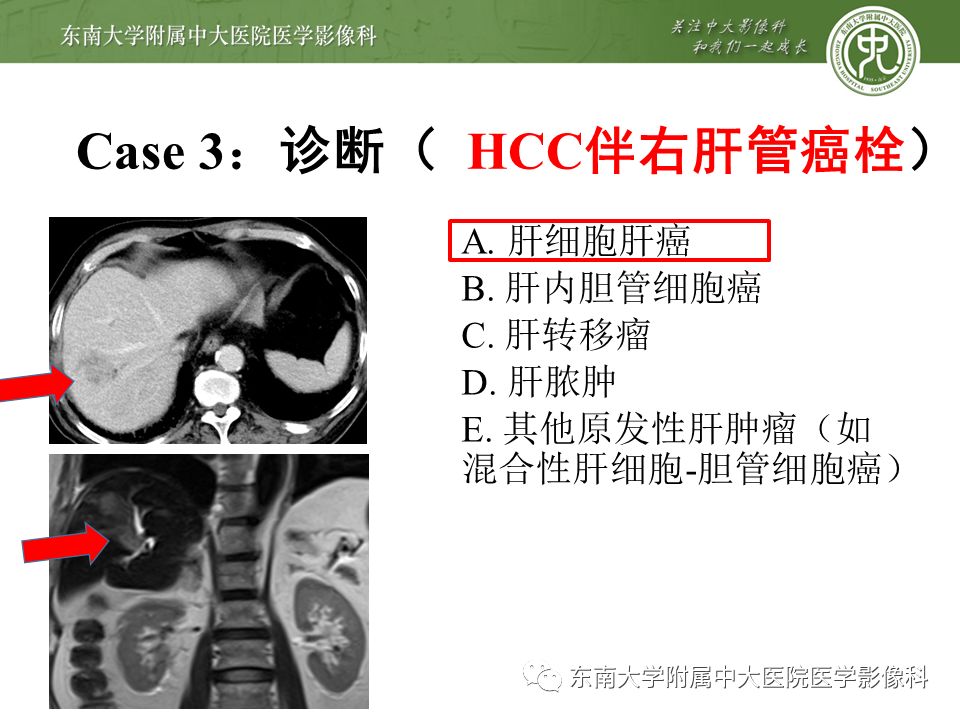【PPT】肝占位性病变(3例)影像随访