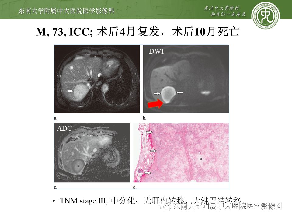 【PPT】肝占位性病变(3例)影像随访
