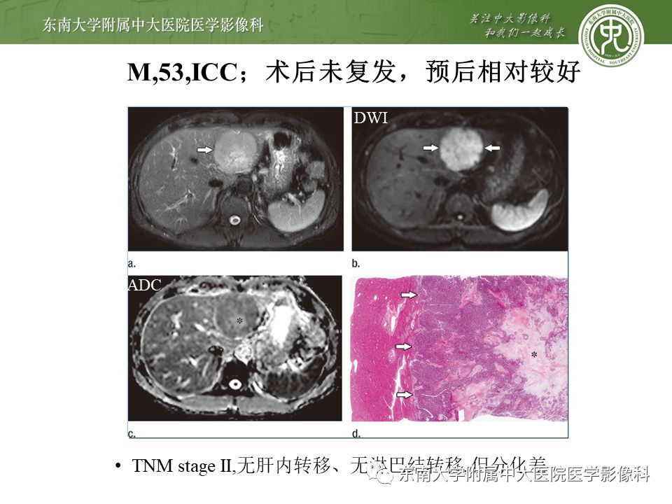 【PPT】肝占位性病变(3例)影像随访