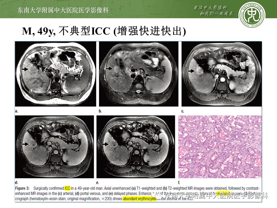 【PPT】肝占位性病变(3例)影像随访