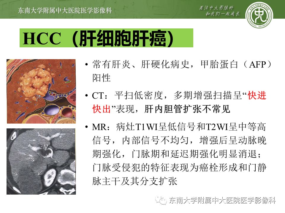 【PPT】肝占位性病变(3例)影像随访