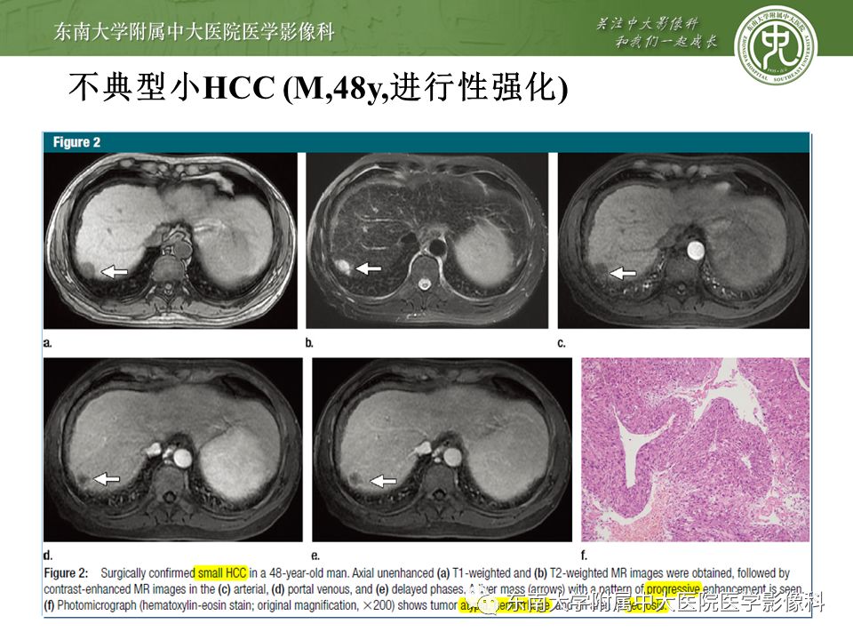【PPT】肝占位性病变(3例)影像随访