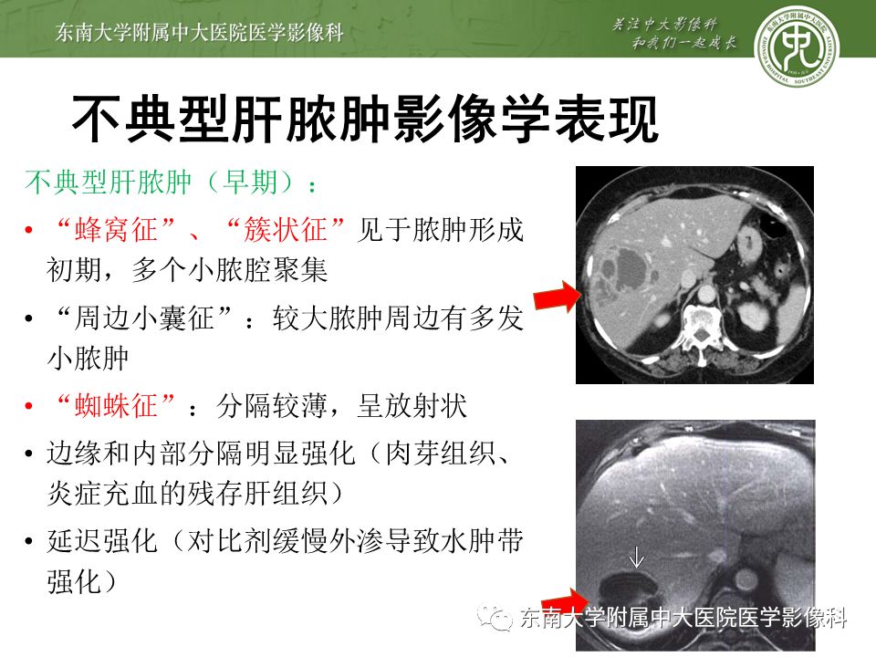 【PPT】肝占位性病变(3例)影像随访