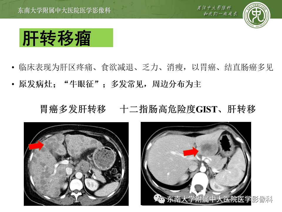 【PPT】肝占位性病变(3例)影像随访