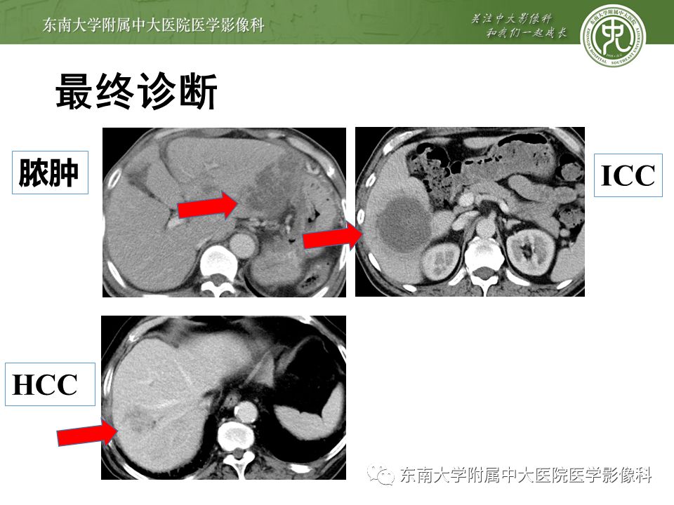 【PPT】肝占位性病变(3例)影像随访