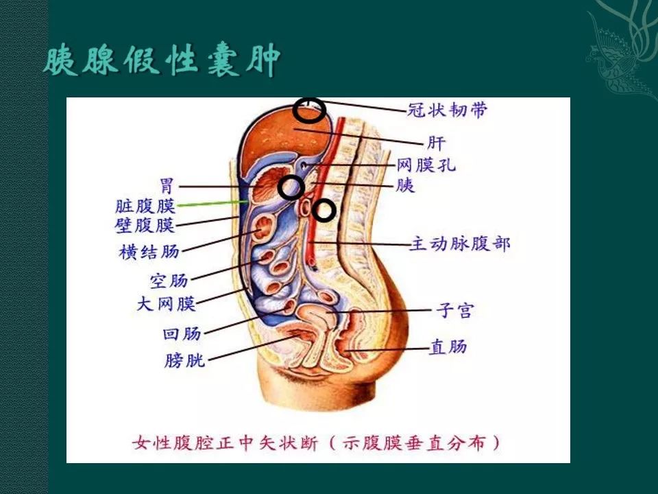 【PPT】胰腺假性囊肿