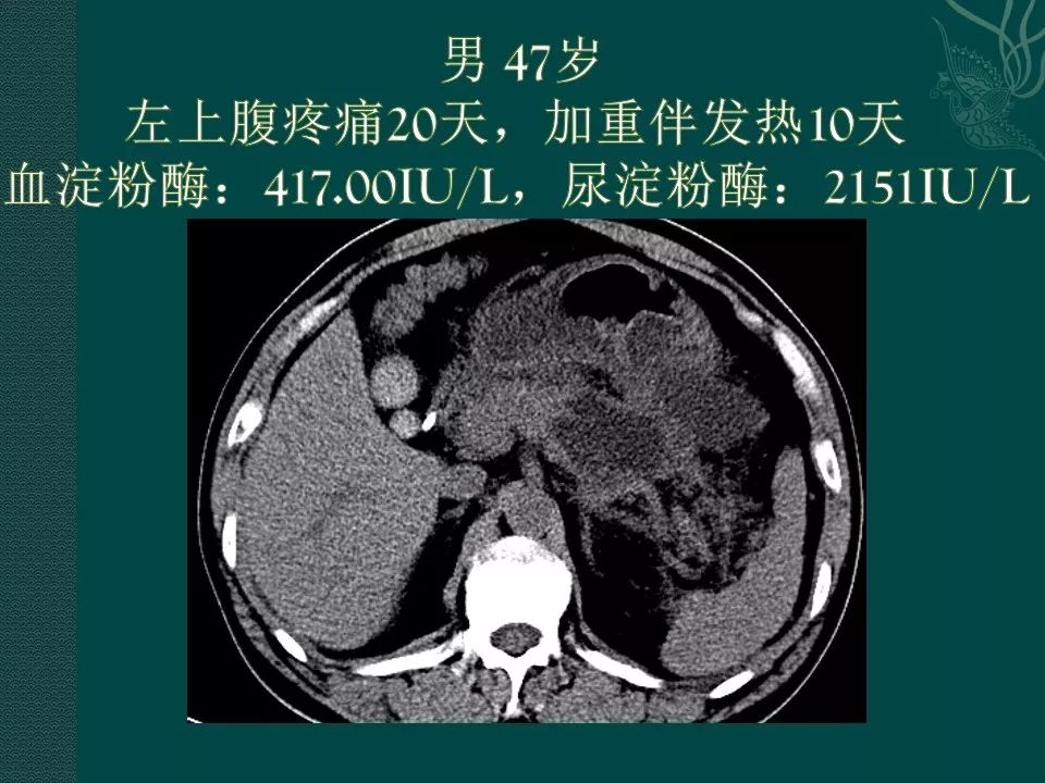 【PPT】胰腺假性囊肿