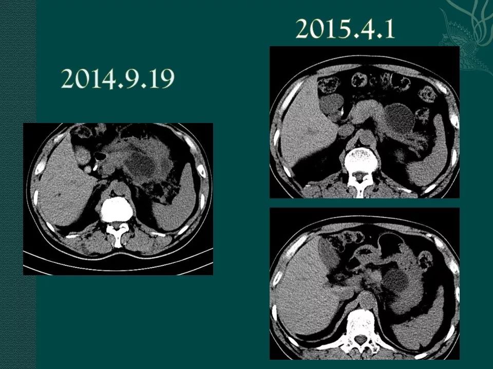 【PPT】胰腺假性囊肿