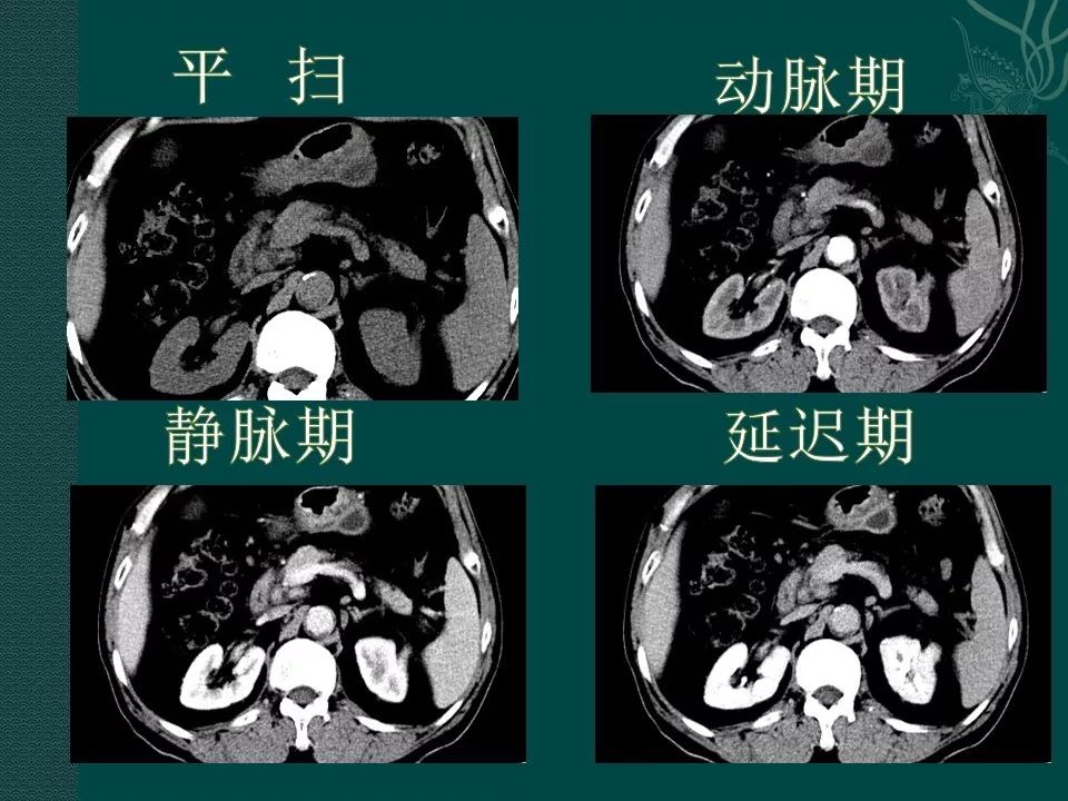 【PPT】胰腺假性囊肿