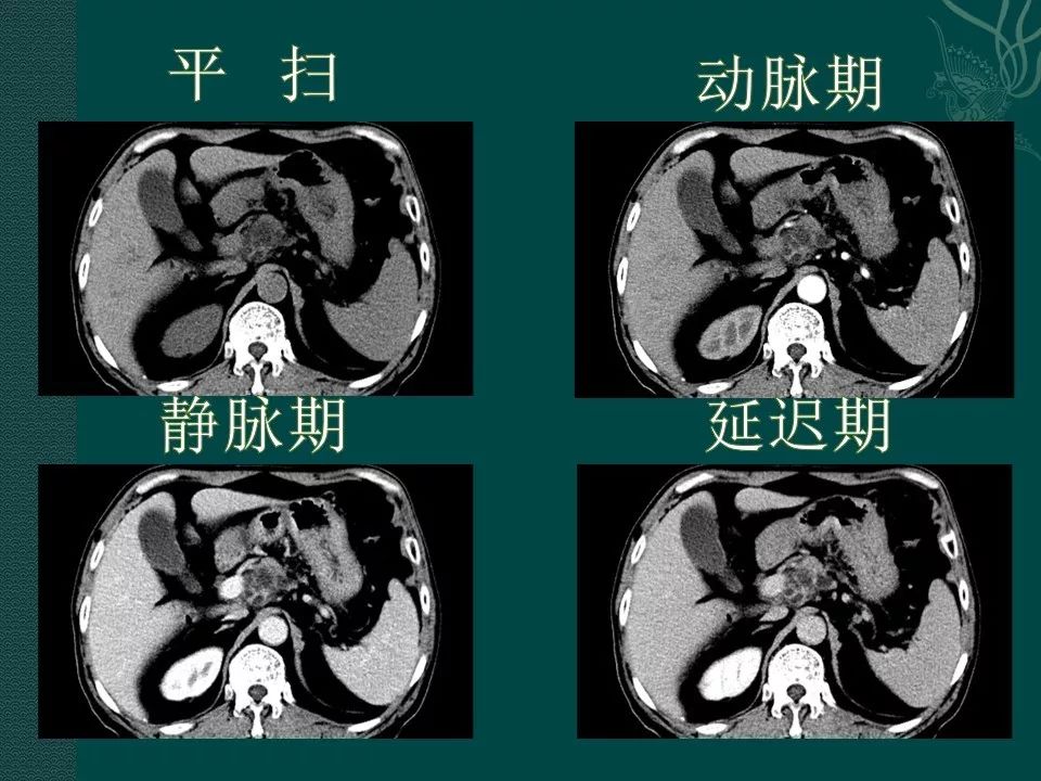 【PPT】胰腺假性囊肿