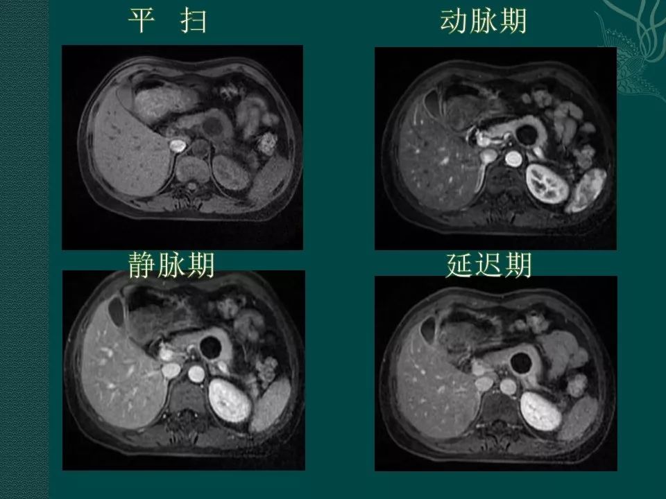 【PPT】胰腺假性囊肿