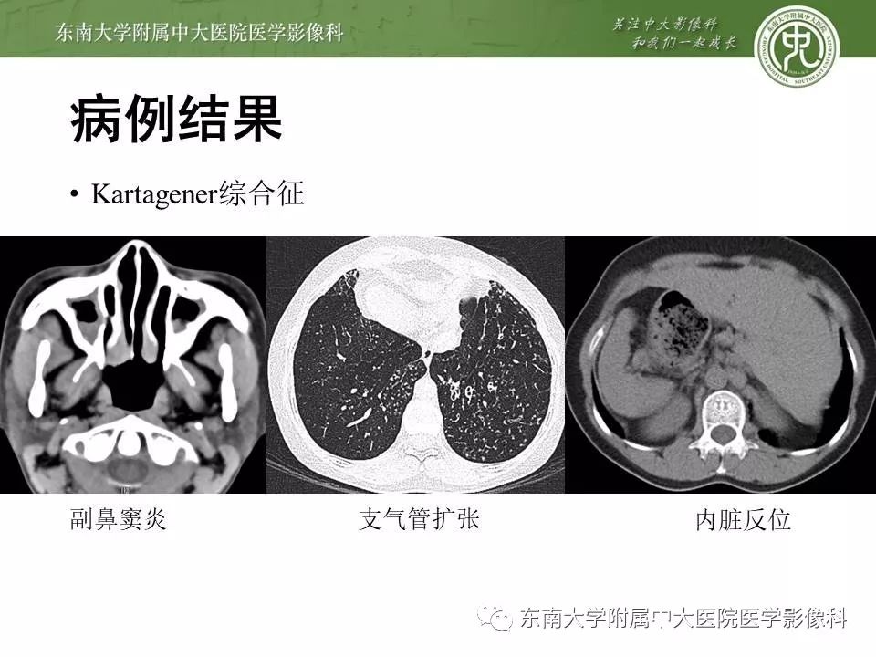 【病例】Kartagener综合征1例CT影像