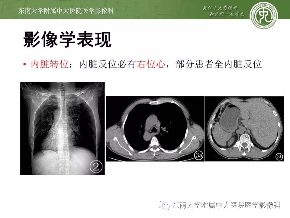 【病例】Kartagener综合征1例CT影像