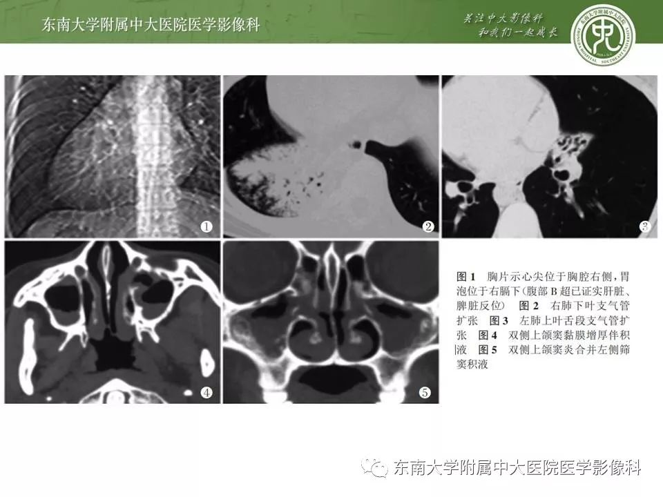 【病例】Kartagener综合征1例CT影像