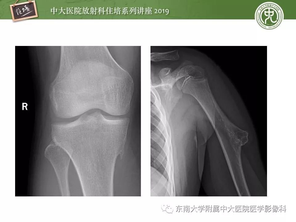 【PPT】常见良性骨肿瘤的影像诊断