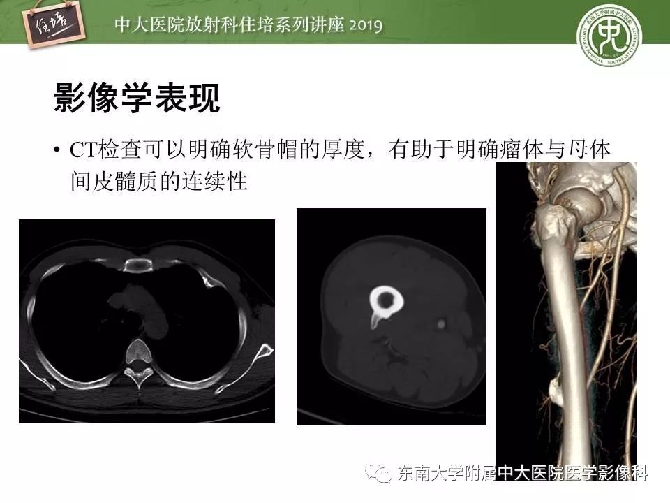 【PPT】常见良性骨肿瘤的影像诊断