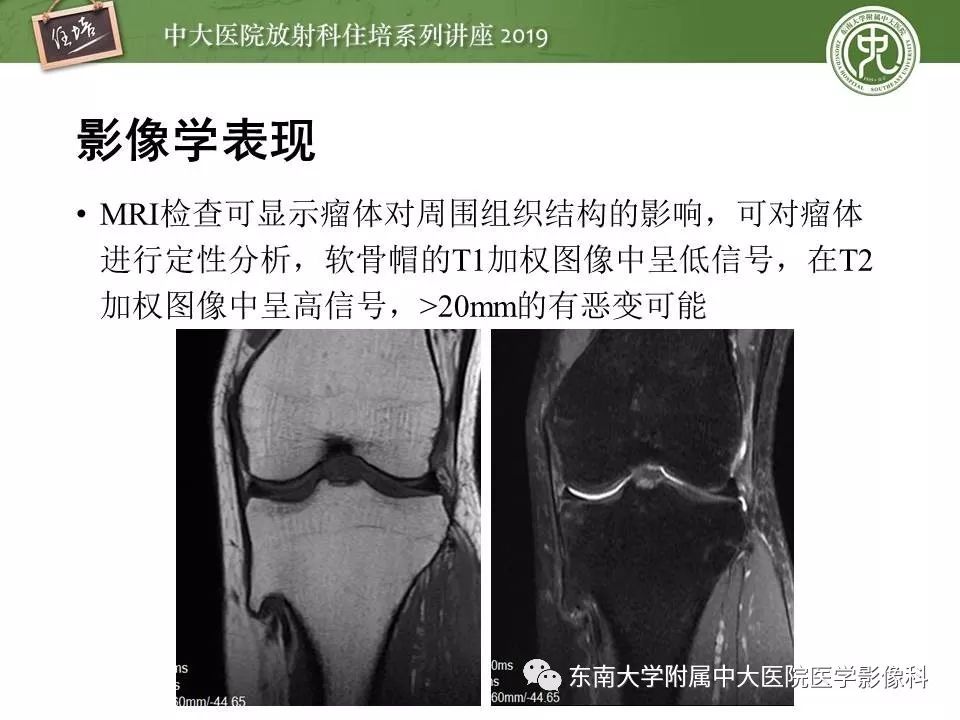 【PPT】常见良性骨肿瘤的影像诊断