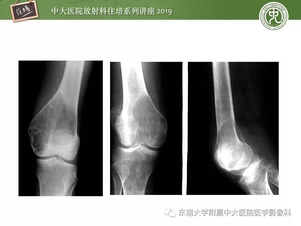 【PPT】常见良性骨肿瘤的影像诊断
