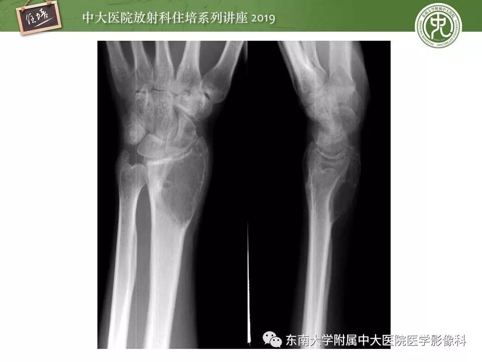 【PPT】常见良性骨肿瘤的影像诊断