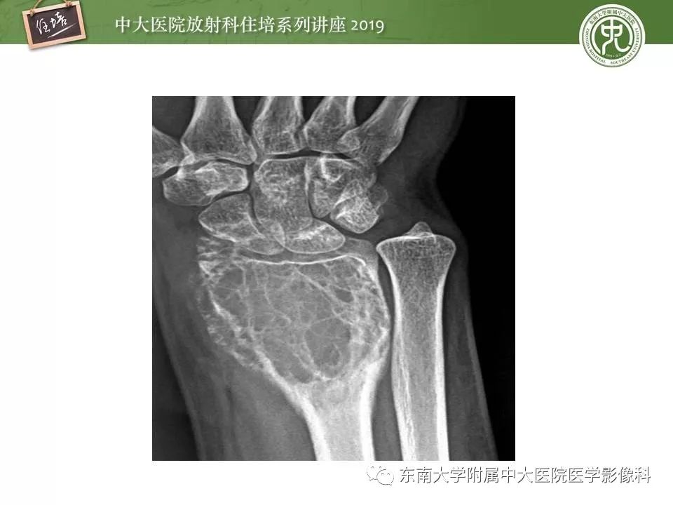 【PPT】常见良性骨肿瘤的影像诊断