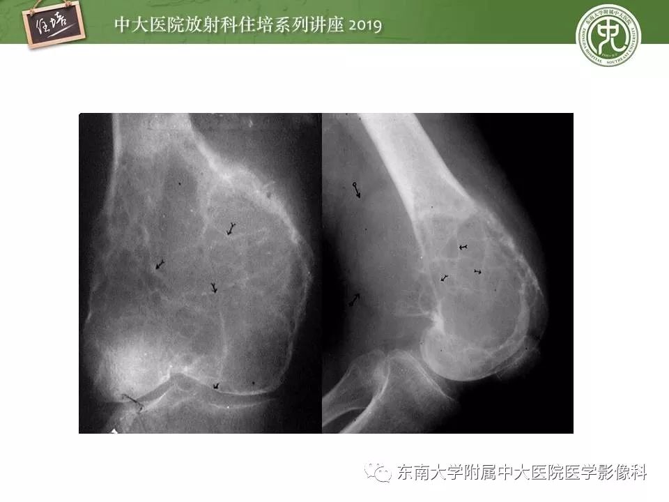 【PPT】常见良性骨肿瘤的影像诊断