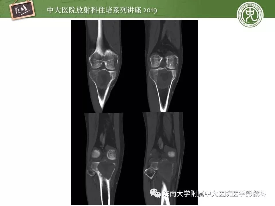 【PPT】常见良性骨肿瘤的影像诊断
