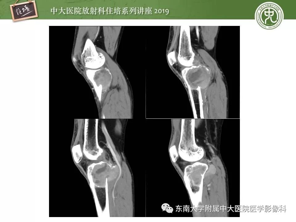 【PPT】常见良性骨肿瘤的影像诊断